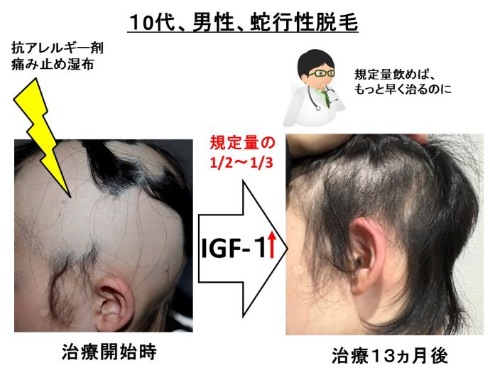 円形脱毛症　病院